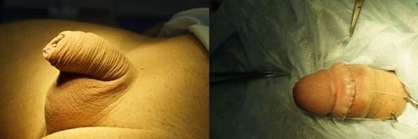 peenis enne ja pärast laienemisoperatsiooni