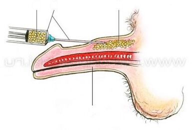süsti peenise suurendamine